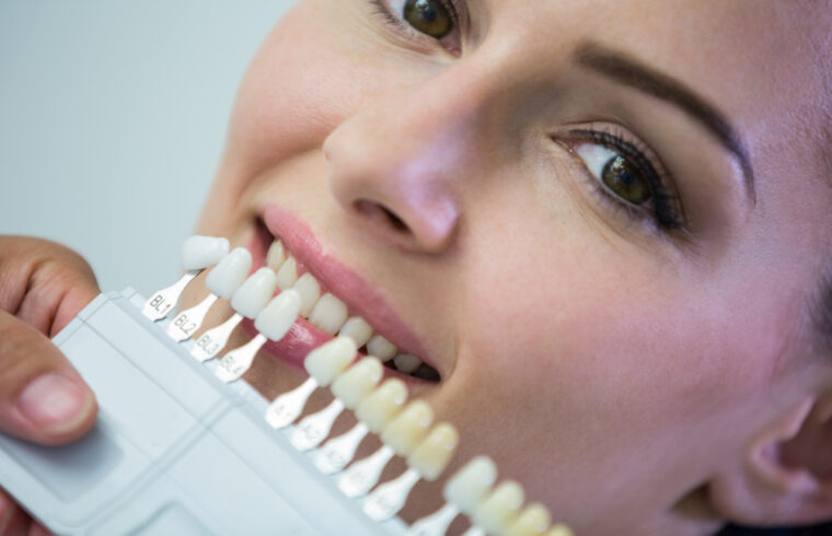 Jakie są różnice między licówkami, a bondingiem?